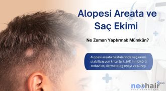Alopesi areata hastalarında saç ekimi kriterleri ve süreç.
